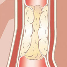 Narrowings in the coronary artery