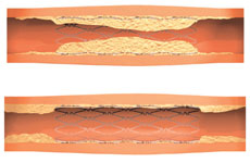 A stent deployed